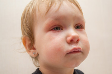 portrait of a child of a girl 1 or 2 years old with a runny nose and red eyes due to an influenza virus or conjunctivitis