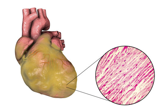 Obese Heart With Left Ventricular Hypertrophy, 3D Illustration And Micrograph