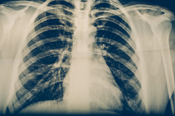 X-ray of a human chest or lungs radiography shot, medical technology and roentgen clinic diagnostic concept