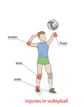 injuries in volleyball. the picture shows the most injured parts of the body when playing volleyball. vector illustration.