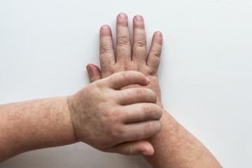 Scarlet fever. Two children's hands with rash on white background.