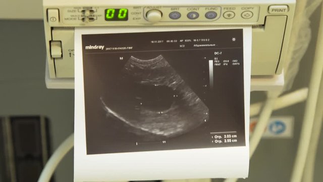 Printing an ultrasound photo in hospital. Ultrasound Machine, Medical Device.