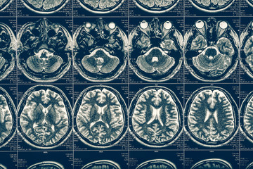 Computer tomography X-Ray brain scan image, internal hydrocephalus, neurology