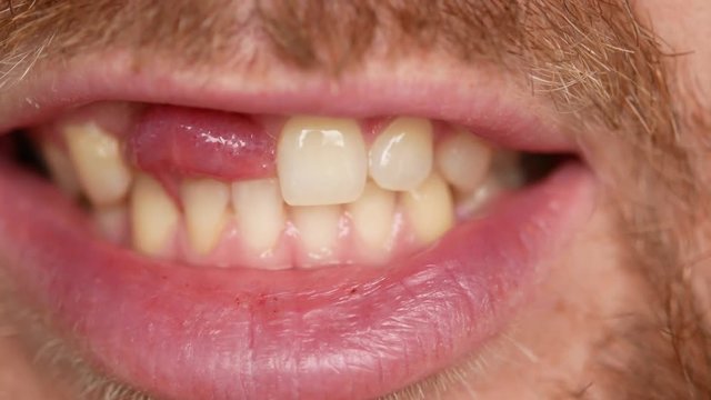 Close-up of teeth. A man shows his denture on two teeth.