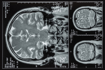Photo MRI ,MRA,of the brain