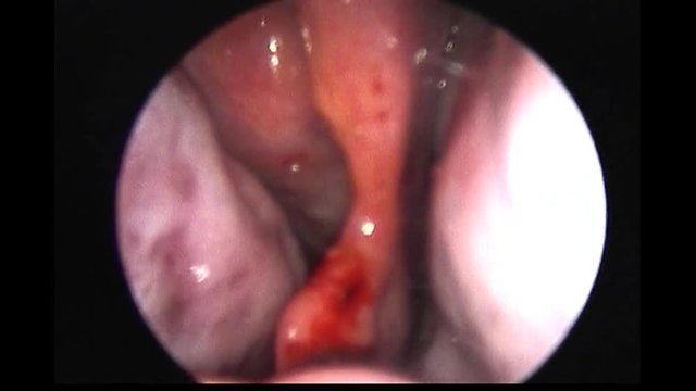 A defect of the nasal septum. Perforation.Endoscopy of the nasal cavity.