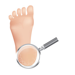 Cracked heels on white background Vector illustration.