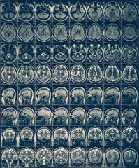 Brain scan X-ray Mri or Magnetic resonance imaging of human head, neurology concept