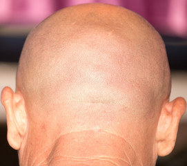 Fototapeta premium Bald head of a man