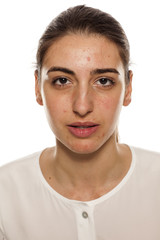 Obraz premium a young woman with a problematic skin on her face
