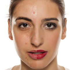 Comparision of before anf after mkeup on young woman with a problematic skin on her face