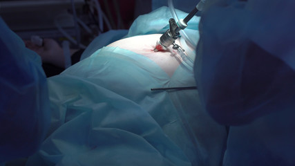 Operation using laparoscopic equipment. Surgeons team. Hospital.