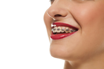 Young smiling woman with braces on white background