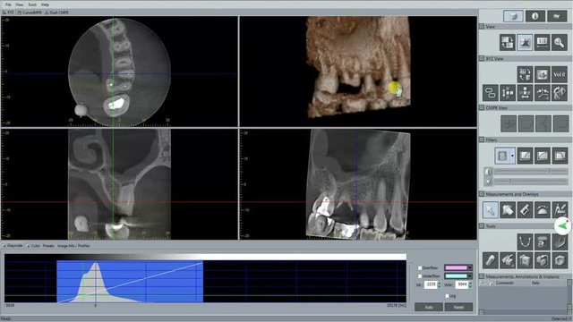 Doctor checking 3D dental scan for future implant