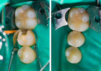 Dental filling comparison, before - after