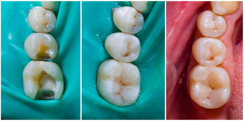 Upper molar and premolar aesthetic filling