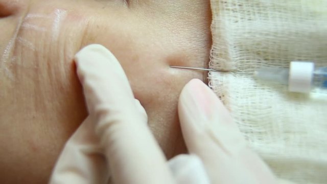introduction of injection under the skin