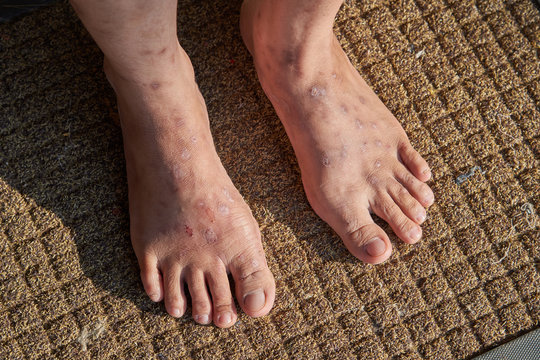 a lot of scars on woman feet.