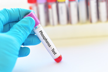 Fototapeta premium Test tube with blood sample for phosphorus test