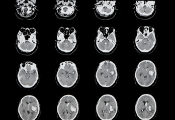 intracerebral hemorrhage