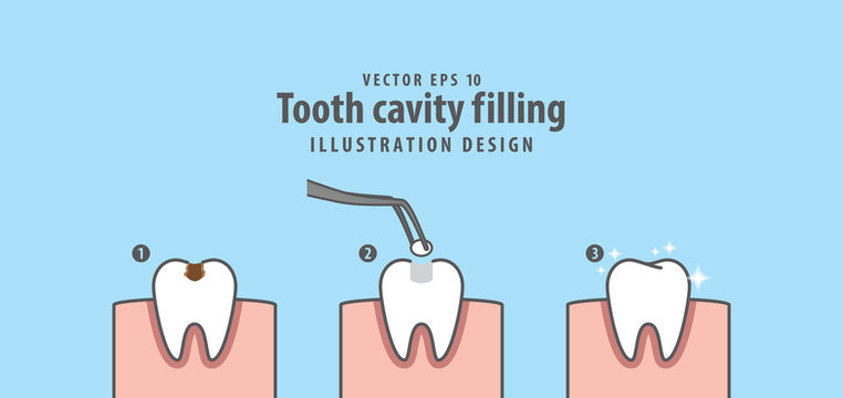 Step of tooth cavity filling illustration vector on blue background. Dental concept.