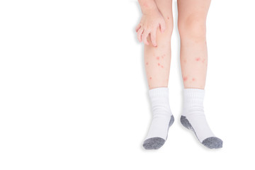 Top view of child's legs with many sore from insect bite over white background