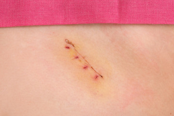 Medicine, closeup of fresh appendix surgery scar, appendectomy