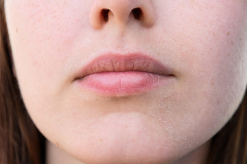 Fototapeta premium The girl with the charred skin on the face around the lips. already hard enough to peel off.