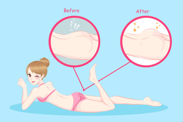 woman with butt implant