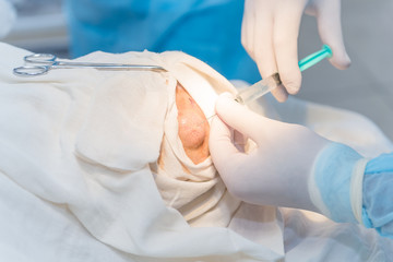 Fototapeta premium hands of an anesthesiologist with a syringe, anesthetizing the patient
