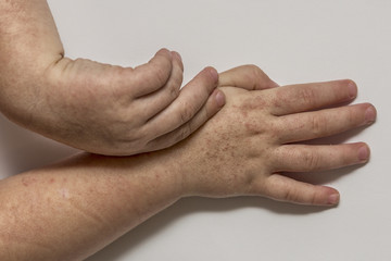 Fototapeta premium Scarlet fever. Two children's hands with rash on white background.