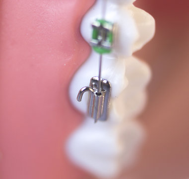 รูปภาพOverbite – เลือกดูภาพถ่ายสต็อก เวกเตอร์ และวิดีโอ3,221 | Adobe Stock