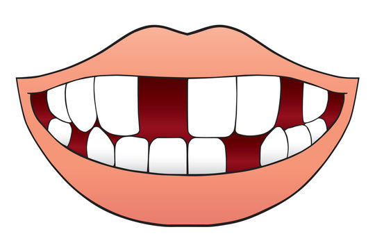 Smiling cartoon mouth with several missing teeth