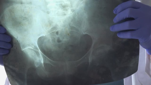 Doctor examining x-ray of the patient's pelvis bone in a medical clinic. Healthcare professional analyzing imaging test for pelvic fractures.