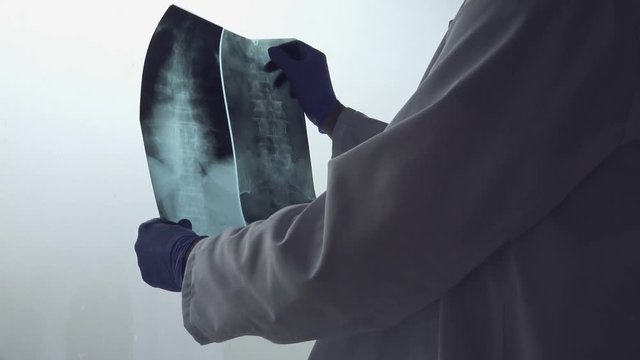 Doctor analyzing x-ray of the patient's spine in a medical clinic. Healthcare professional examining imaging test for abnormalities in human backbone.
