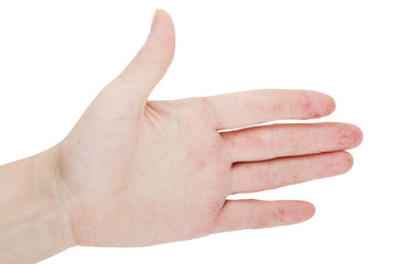 Female hand with dermatitis