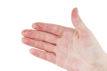 Female hand with dermatitis - 185908725