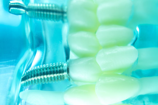 Dental titanium tooth implant