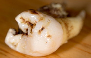 Caries on the teeth of a man