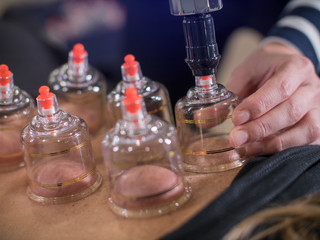 Air Cupping procedure