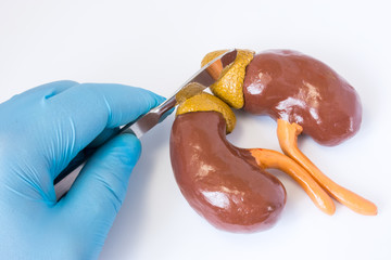 Adrenal gland surgery concept photo. 3D anatomical shape of adrenal gland and kidneys next to  surgeon hand in blue glove holding scalpel. Surgery operation in cancer, tumor, pheochromocytoma, adenoma