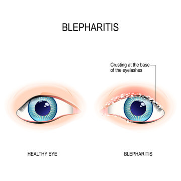 Eyes of human. Blepharitis. Crusting at the eyelid margins