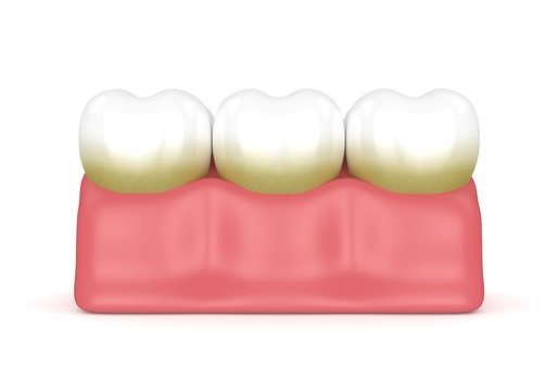 3d Render Of Teeth With Plaque And Tartar