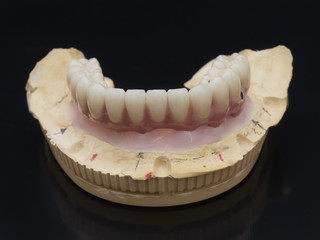 Complete lower and upper metal ceramic prosthesis dental screwed directly to implant.