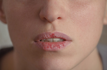 Dermatillomania skin picking. Woman has bad habit to picks her lips. Harmful addiction based on anxiety stress and dry lips. Excoriation disorder. Sick cracked damaged tissue.