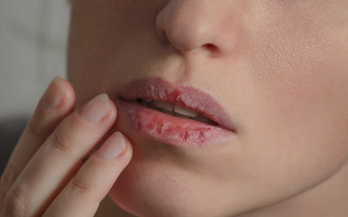 Dermatillomania skin picking. Woman has bad habit to picks her lips. Harmful addiction based on anxiety stress and dry lips. Excoriation disorder. Sick cracked damaged tissue. - obrazy, fototapety, plakaty