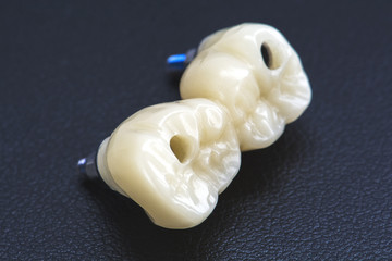 Temporary crowns on implants