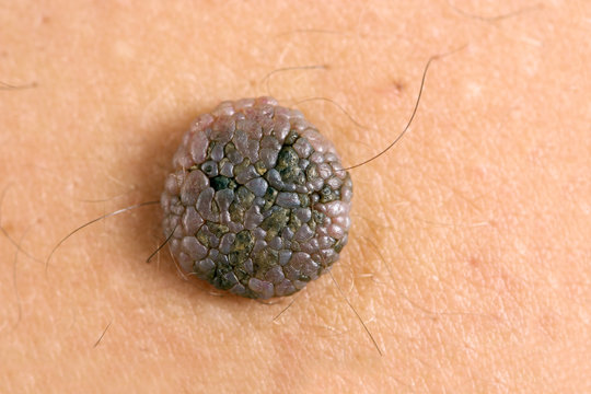 Close up photo of a mole on the skin