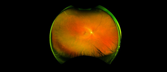 eye's retinal angle image with macula, vessels and optic disc isolated view on a black bacground....