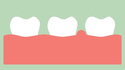 gingivitis or gum disease, gum inflammation before periodontal disease - dental cartoon 2d animation in 4K